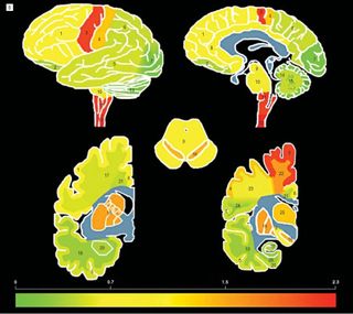 Whole-brain density map of TDP-43 distribution throughout central nervous system of ALS patients. Red, orange, and yellow depict areas of highest density of TDP-43 pathology.  Image Credit: Felix Geser and Nick Brandmeir, University of Pennsylvania; Archives of Neurology